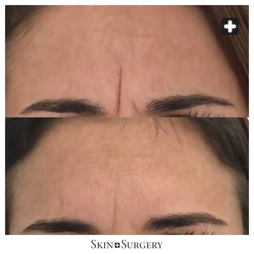 Botox treatment in Leiden