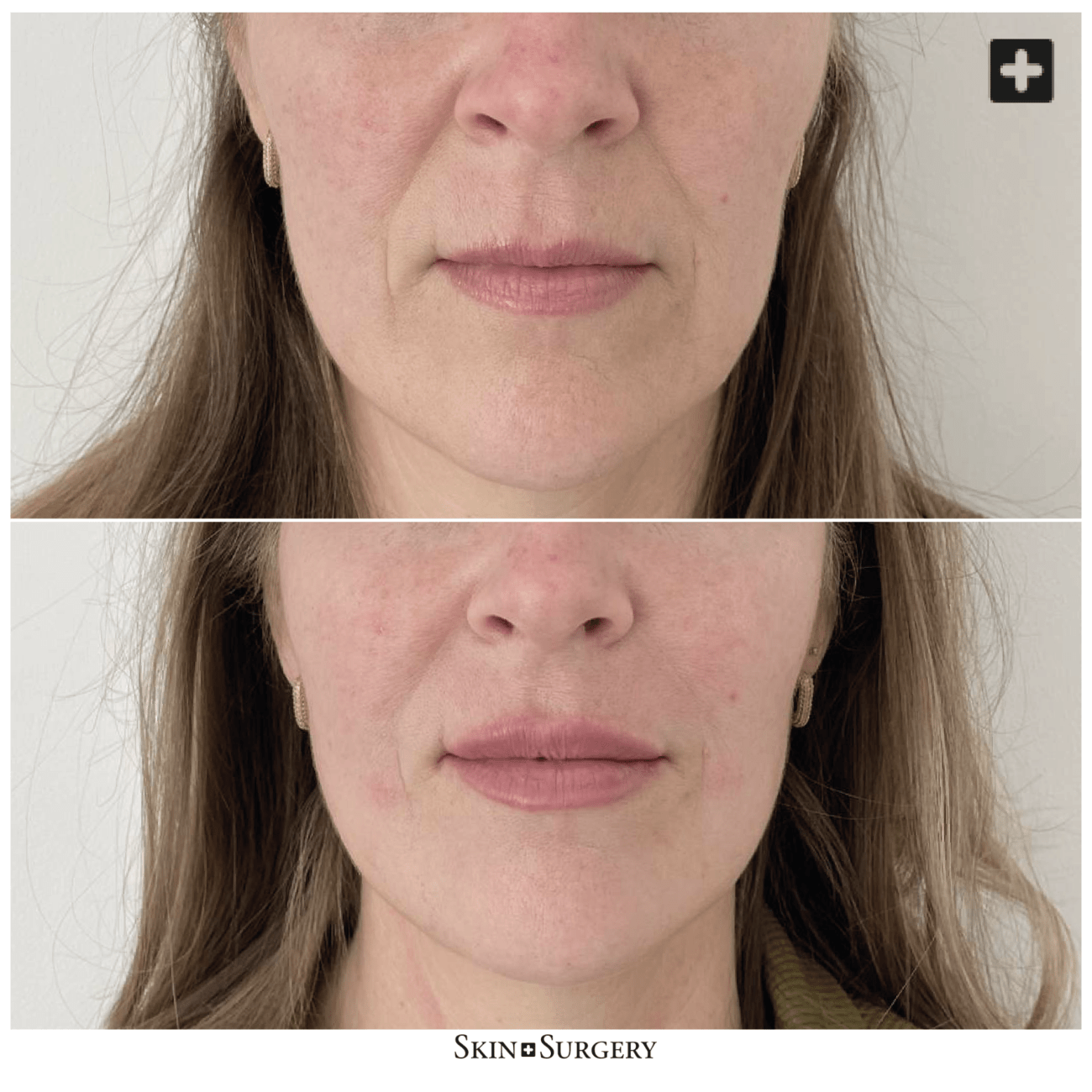 Behandeling botox voor lippen