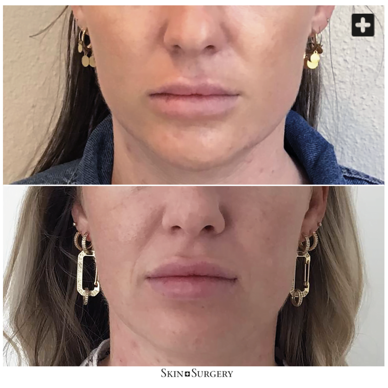 Botox lippen