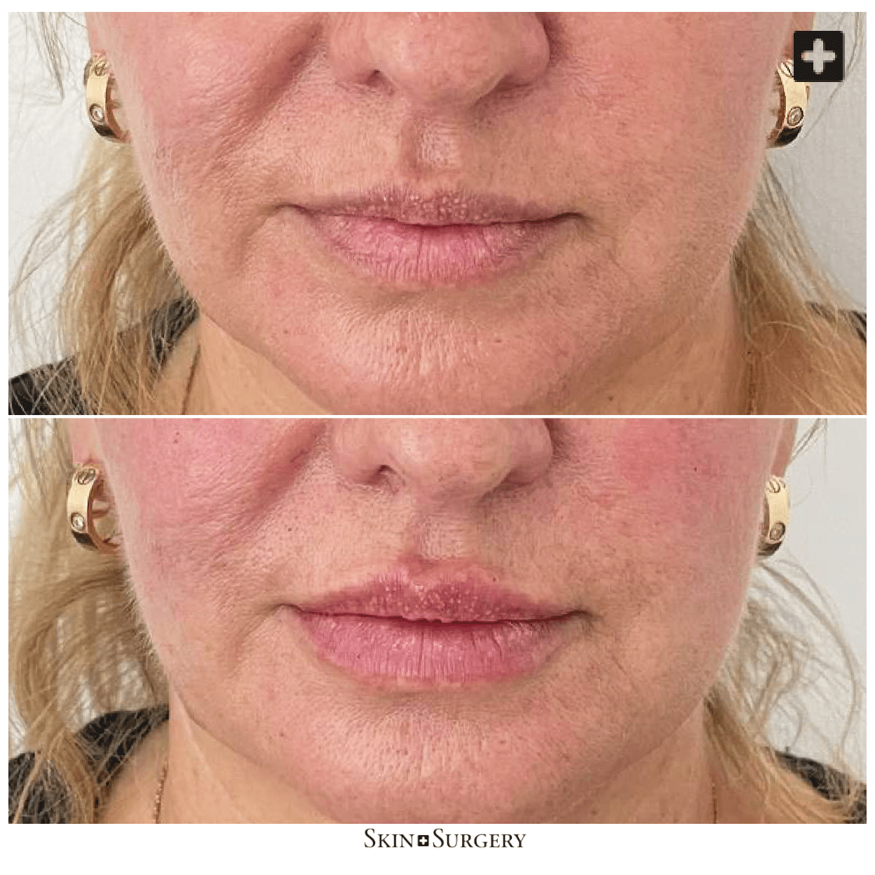 Botox voor de lippen