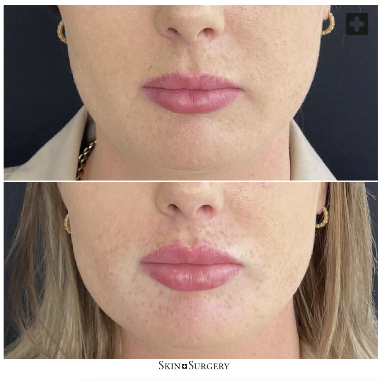 Botoxbehandeling lippen
