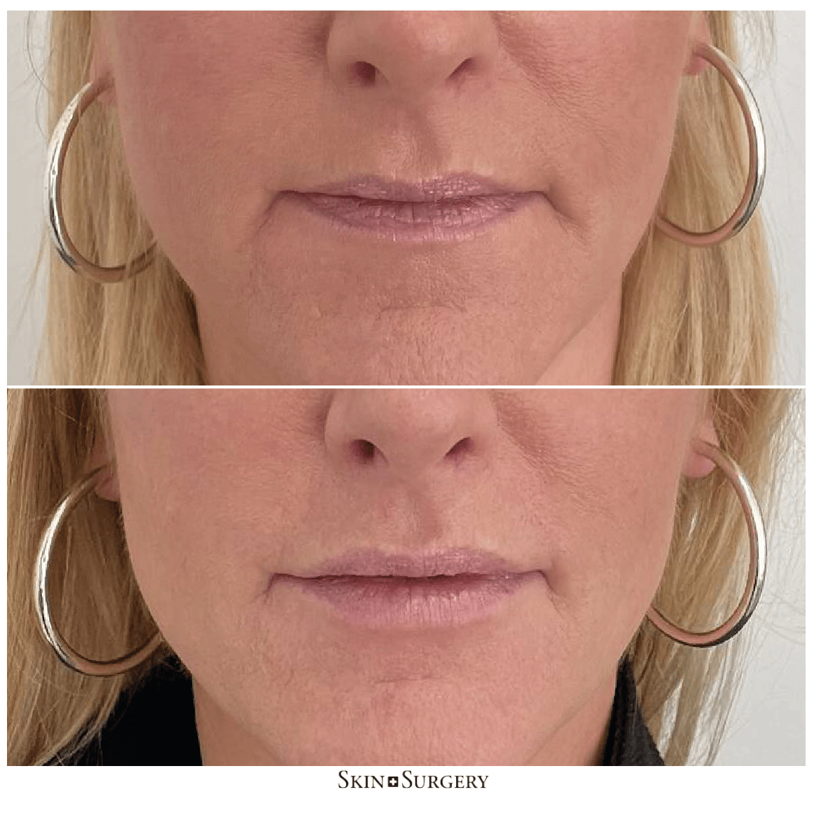 Botoxbehandeling voor lippen