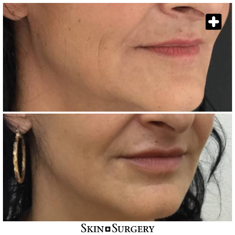 Behandeling botox lippen