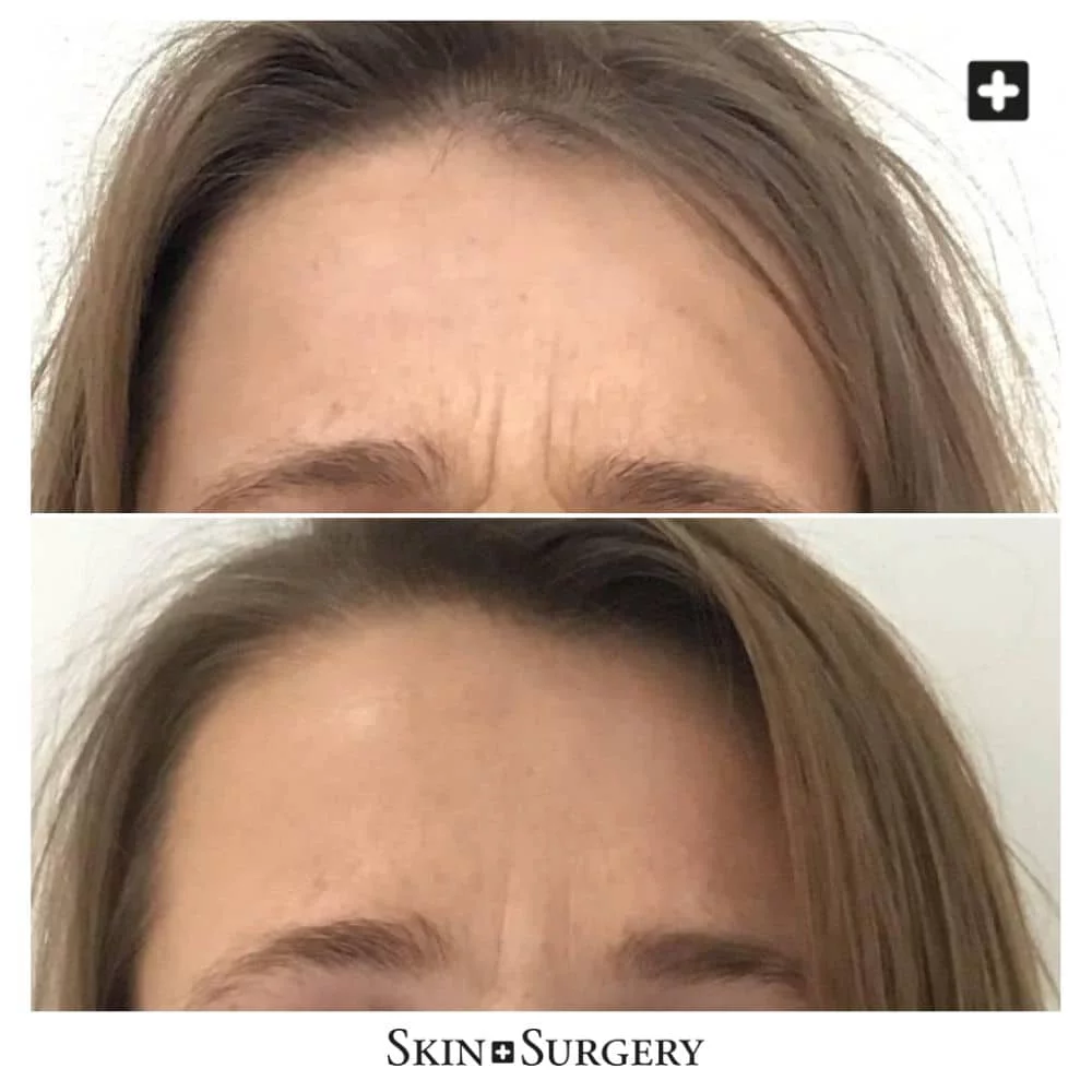 Botox treatment The Hague