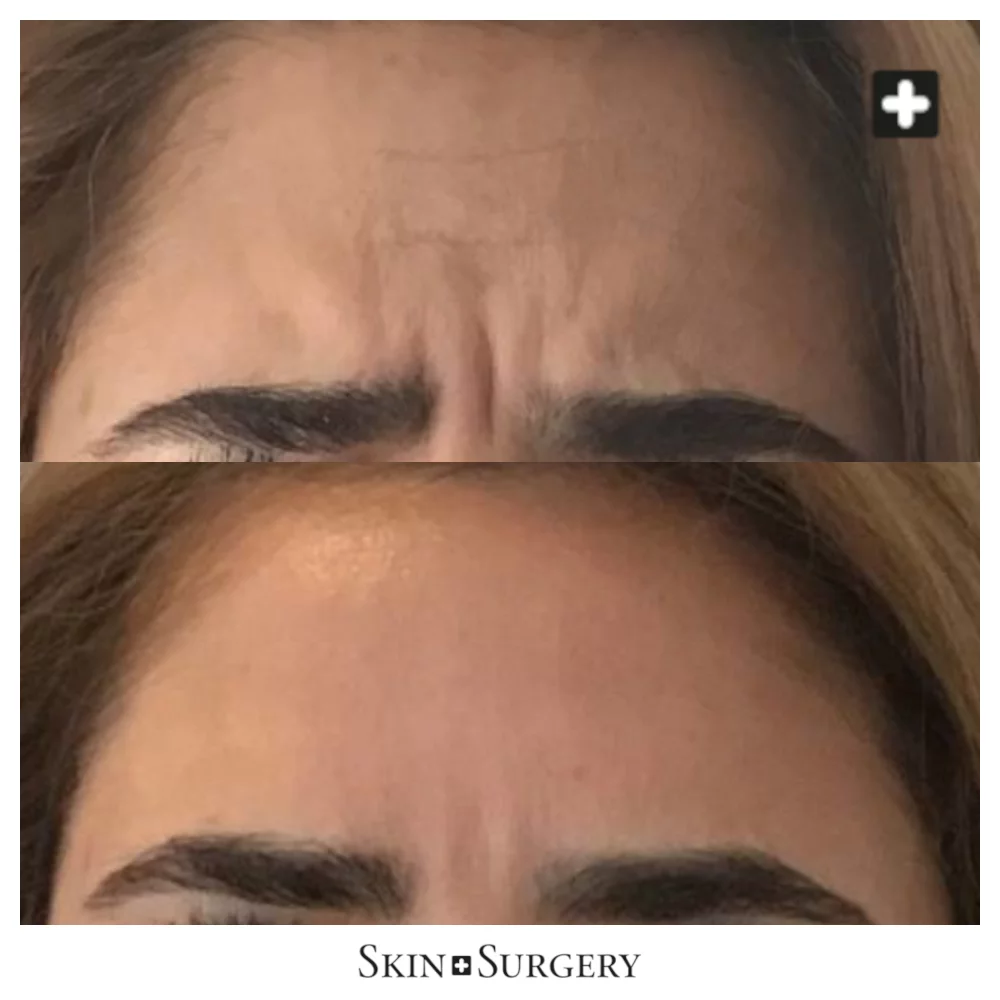 Botox voor gezicht