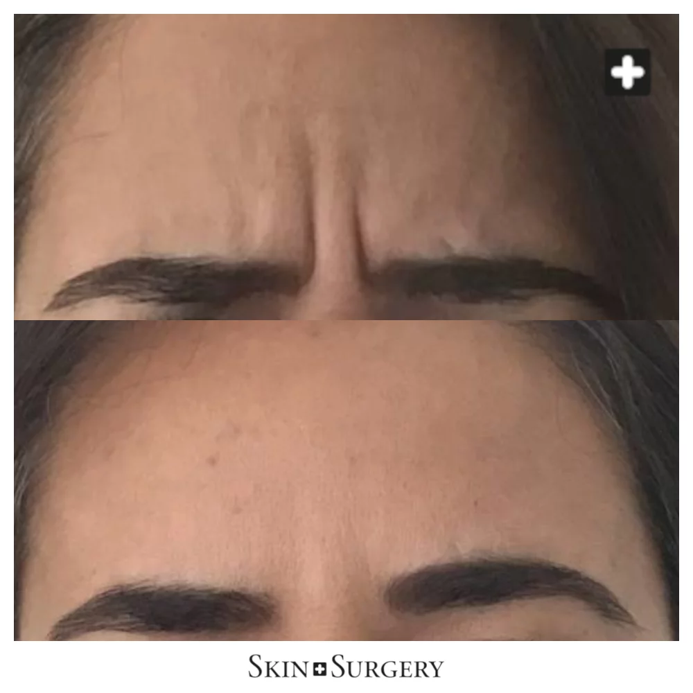 Botox face