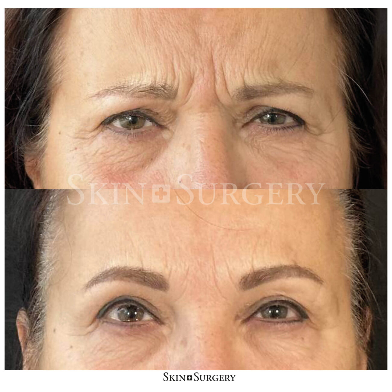 Gezicht botox
