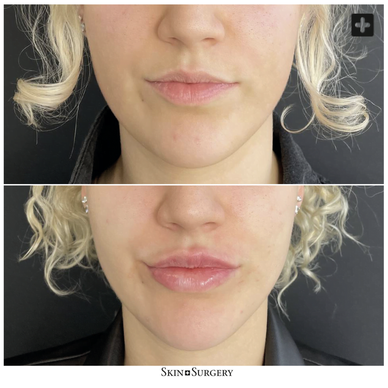 Lippenbehandeling botox