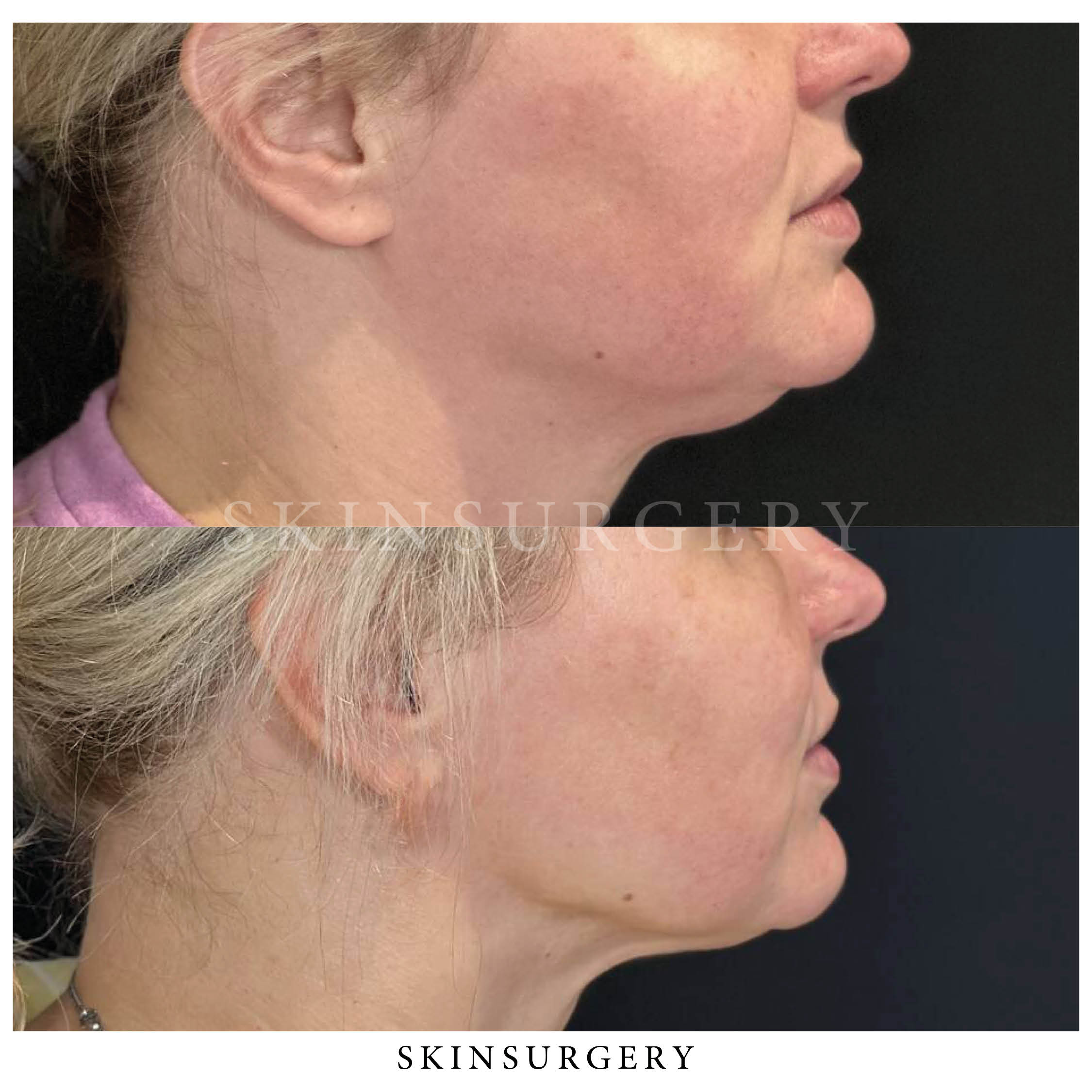 Lipolaser behandeling skinsurgery clinics