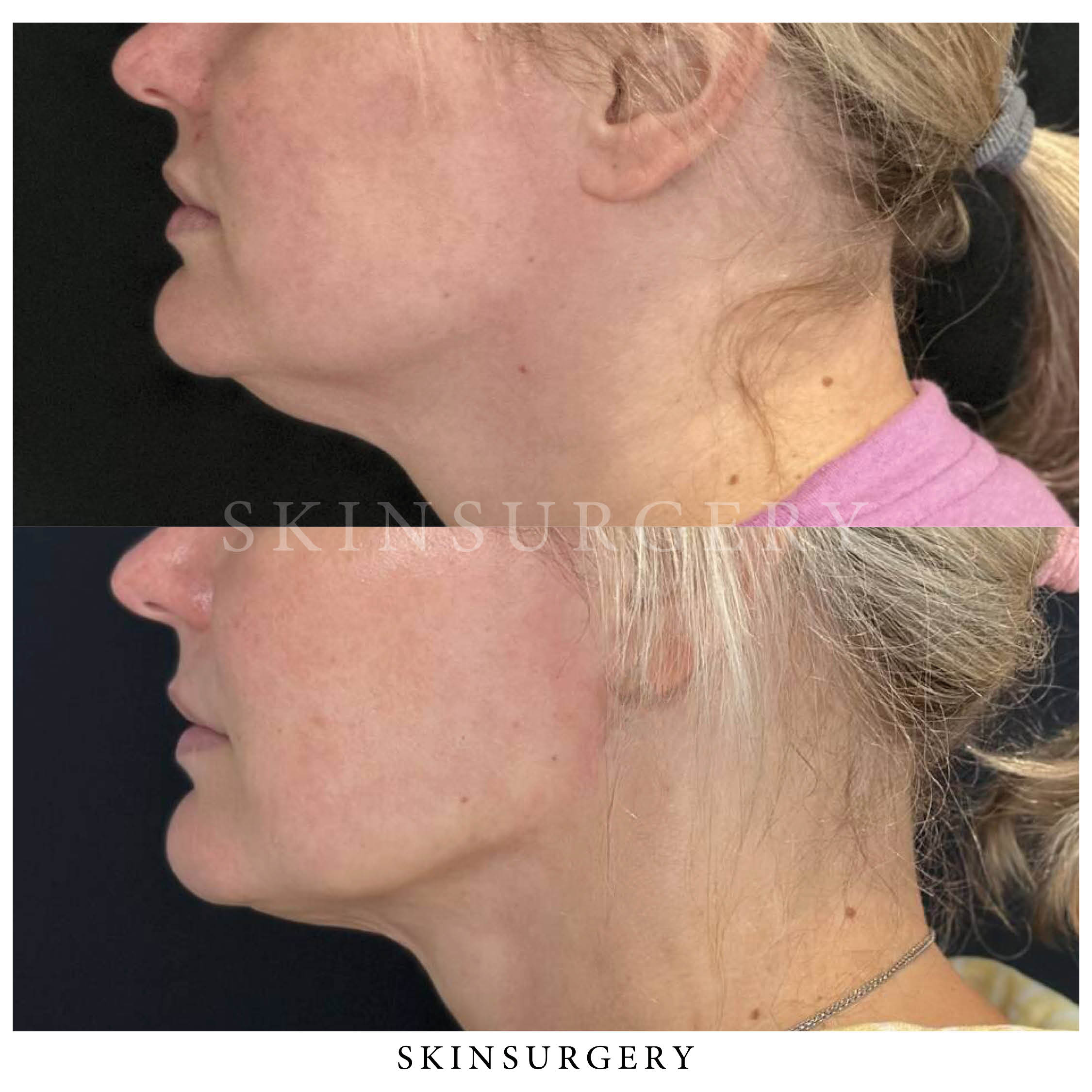 Liposuctie Lipolaser behandeling skinsurgery