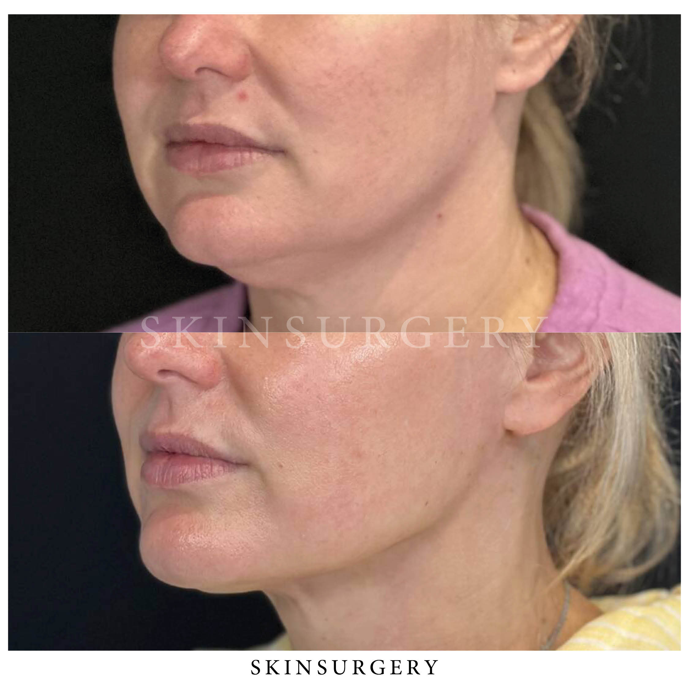 Onderkin verwijderen skinsurgery clinics