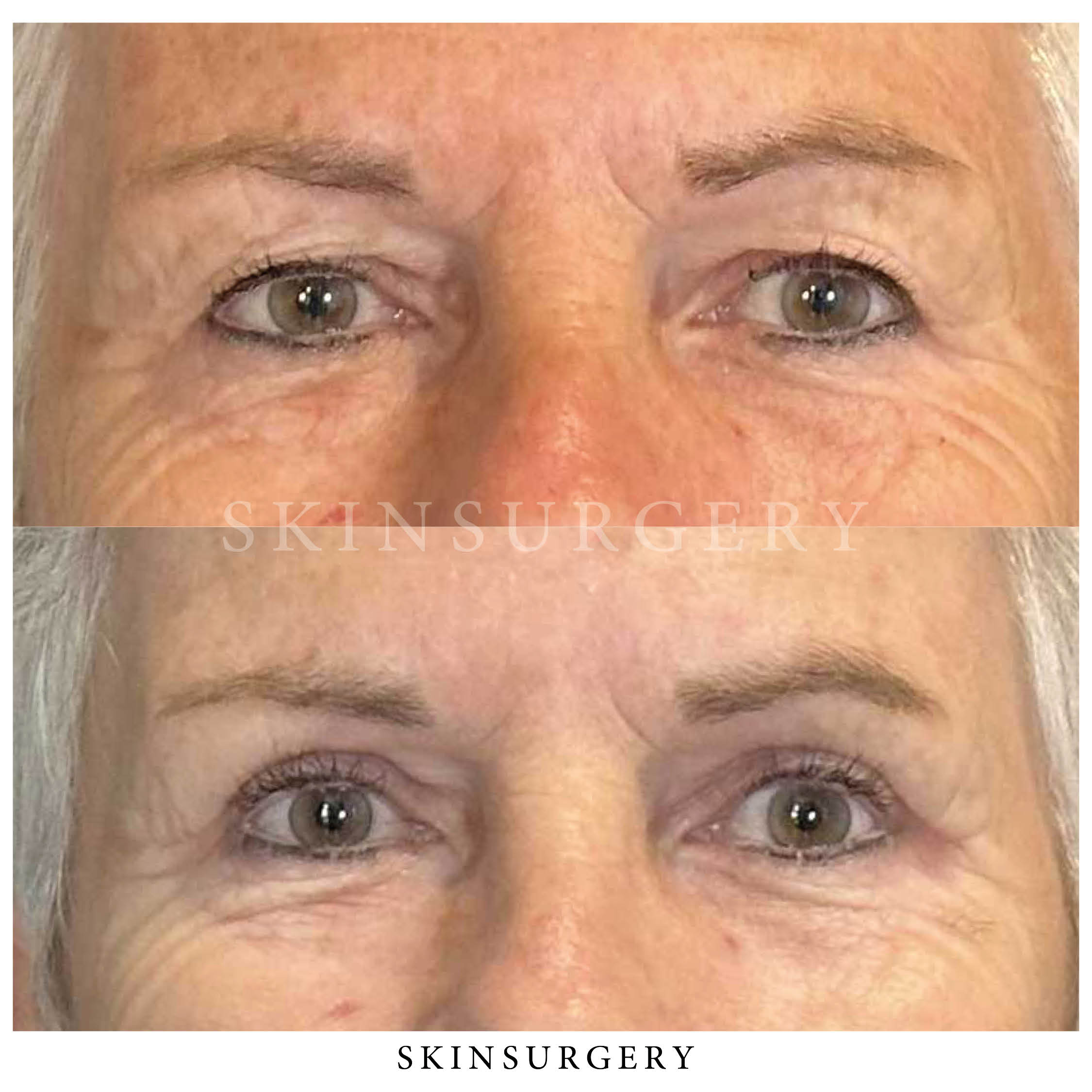 Bovenooglidcorrectie uitgevoerd door Drs. Suzanne van Soest