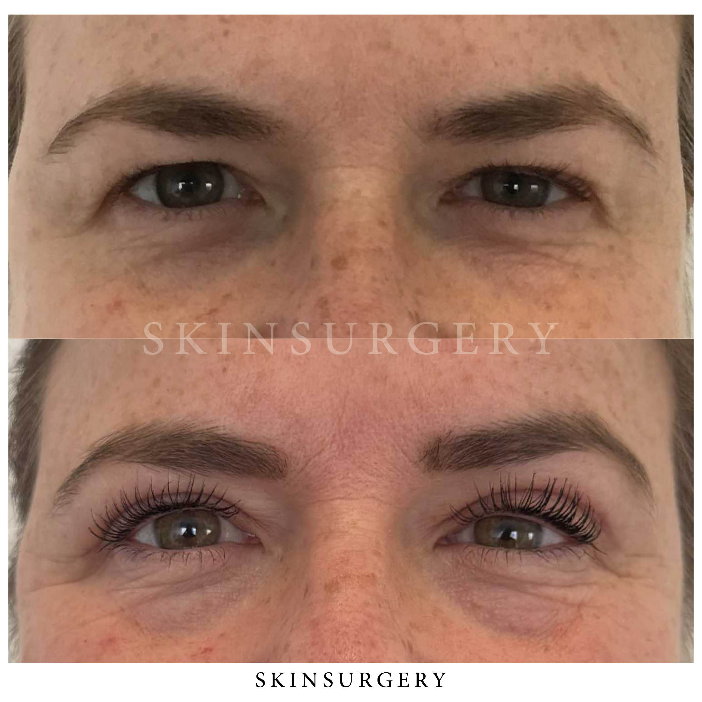 Ooglidcorrectie door Thanya Tha In SkinSurgery Clinics