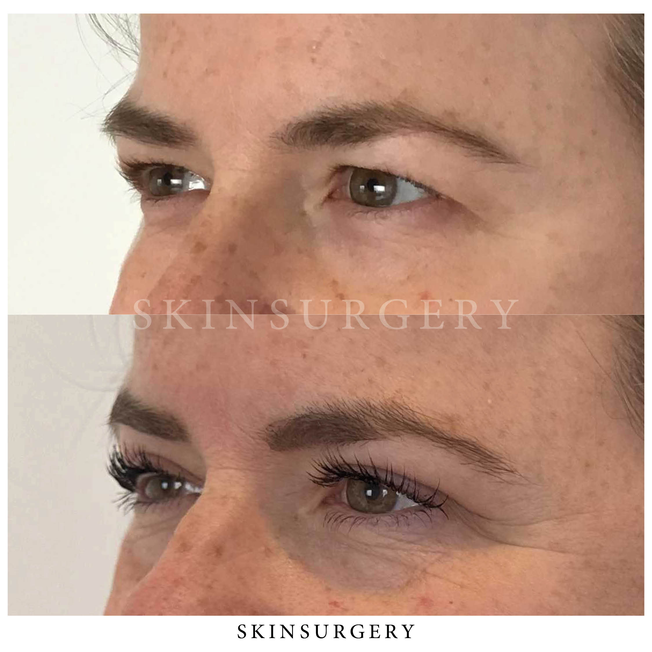 Ooglidcorrectie natuurlijke oogvorm SkinSurgery Clinics