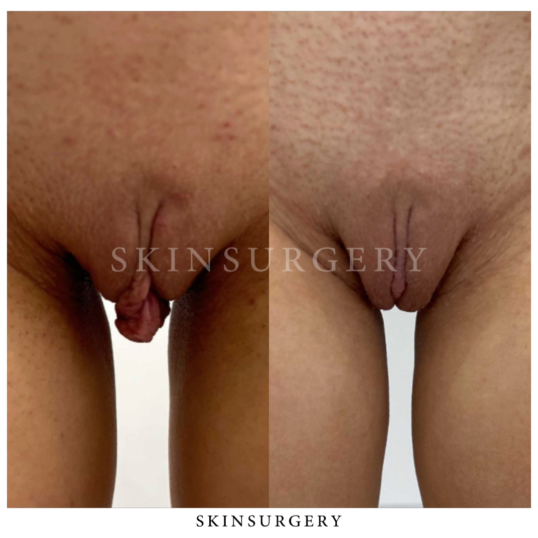 Labia Schaamlipcorrectie SkinSurgery