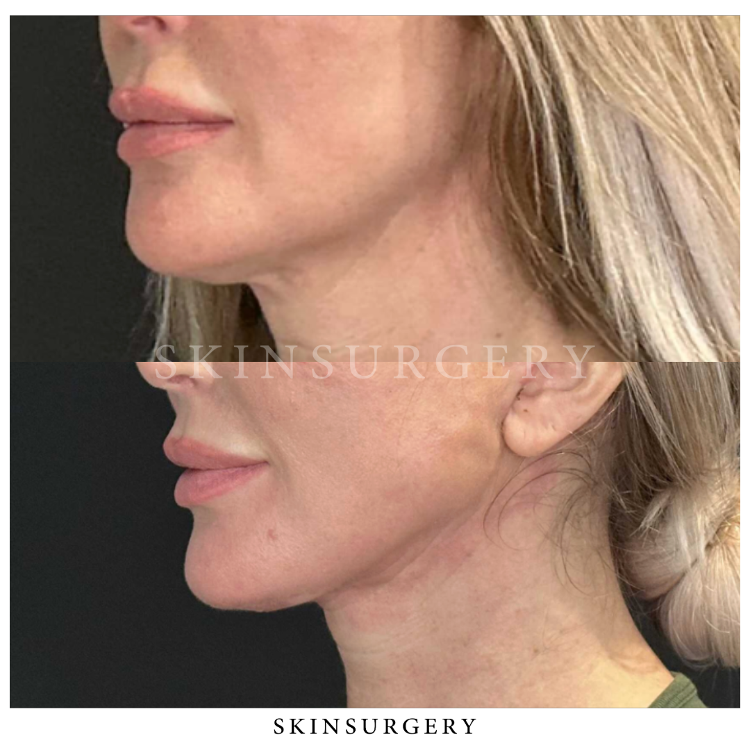 Snatchlift Facelift SkinSurgery 1