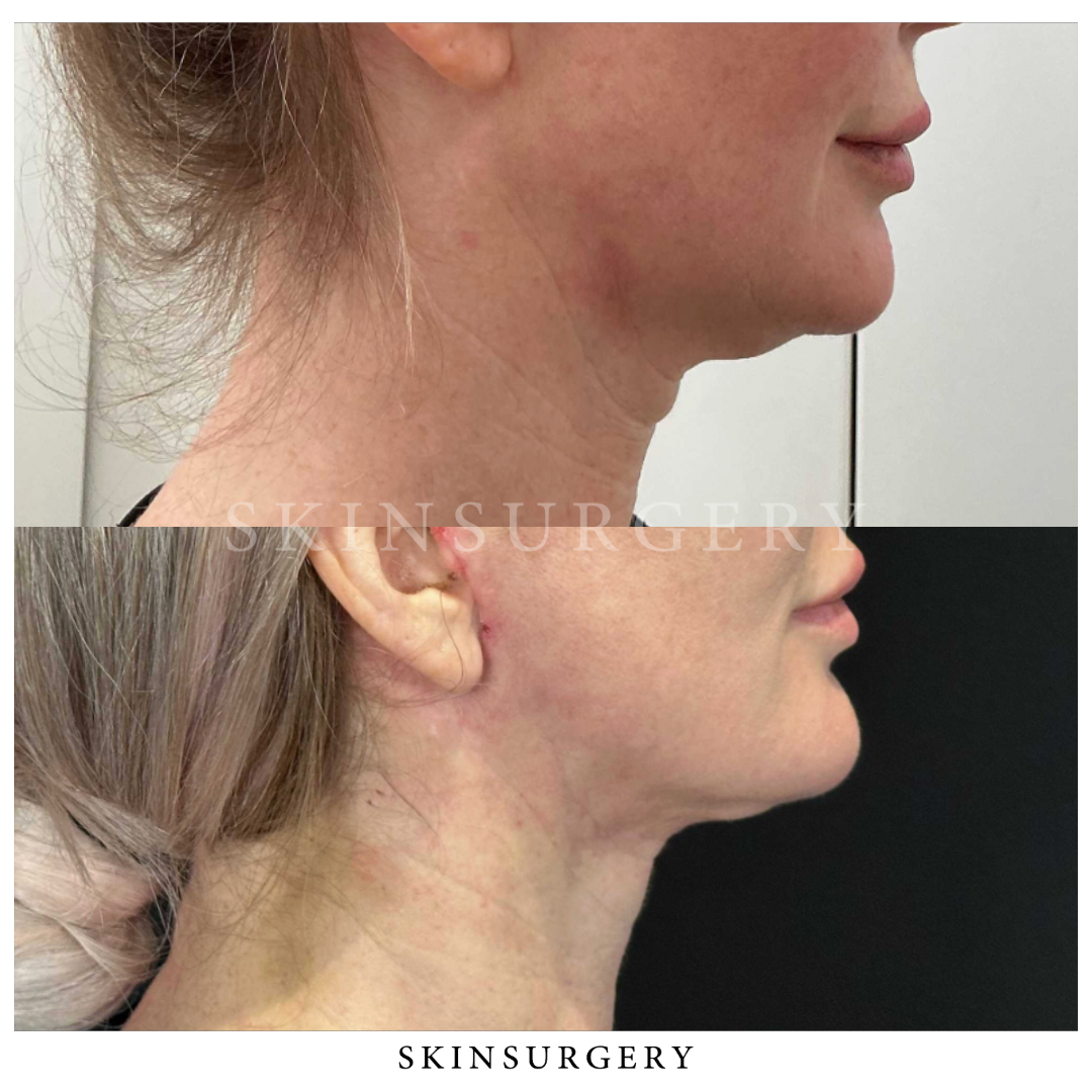 Snatchlift Facelift SkinSurgery