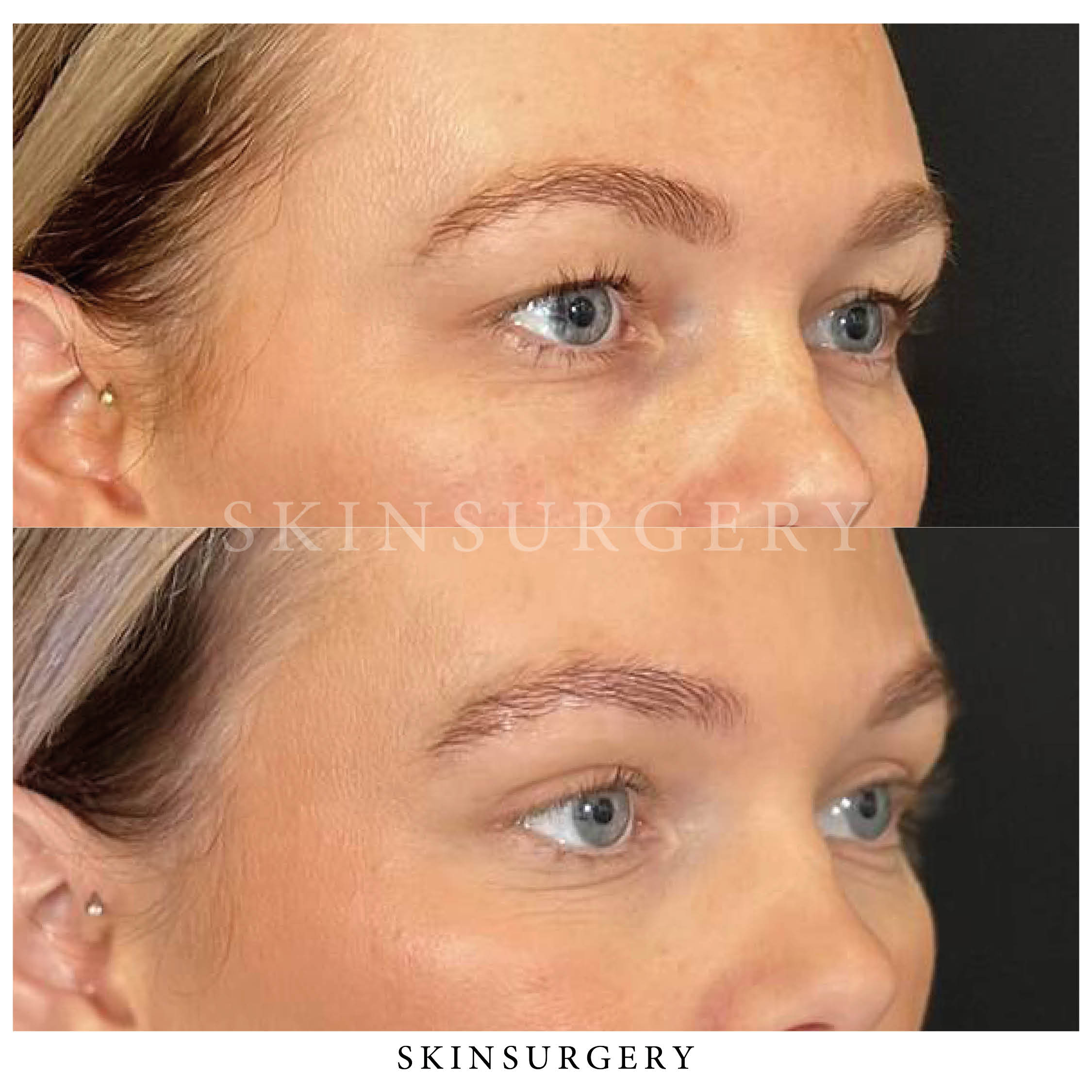 Voor na ooglidcorrectie skinsurgery clinics4