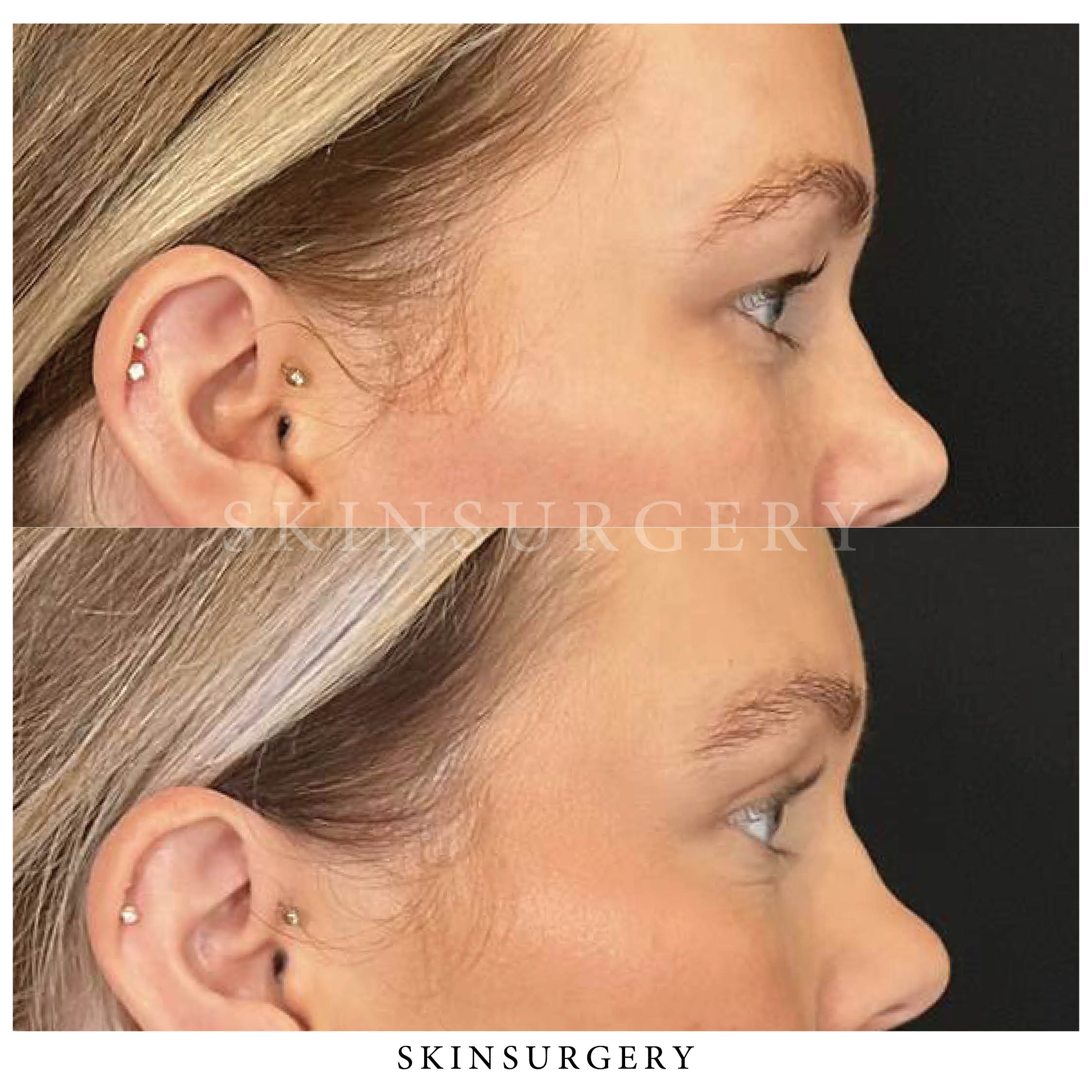 Voor na ooglidcorrectie skinsurgery clinics5