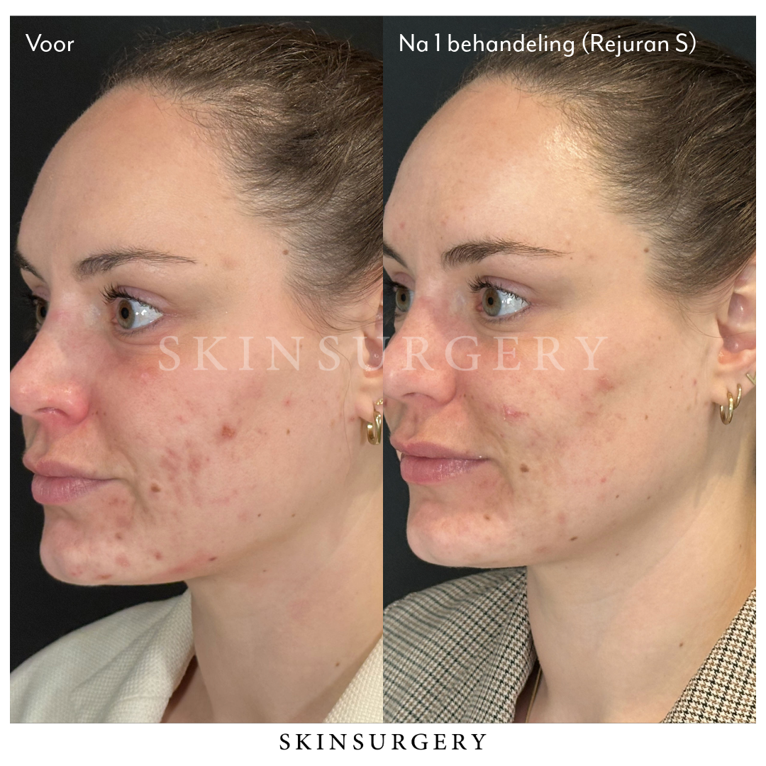 Voor en na Rejuran Behandeling SkinSurgery Clinics Bergschenhoek Den Haag Rotterdam